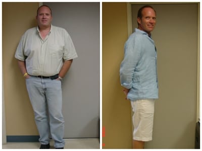 Patient who has undergone bariatric surgery - before and after