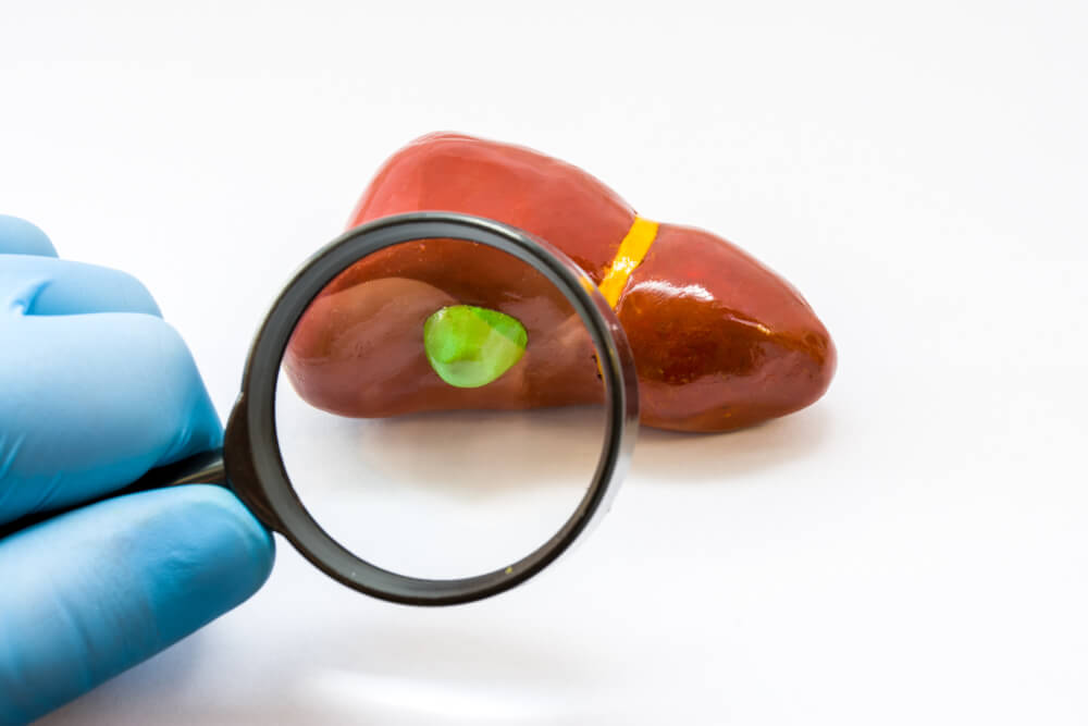 Diagnosis Of Gallbladder For Presence Of Disease. Doctor Hand In Glove Examine With Magnifying Glass Gallbladder On Liver Anatomical Model On White Background.