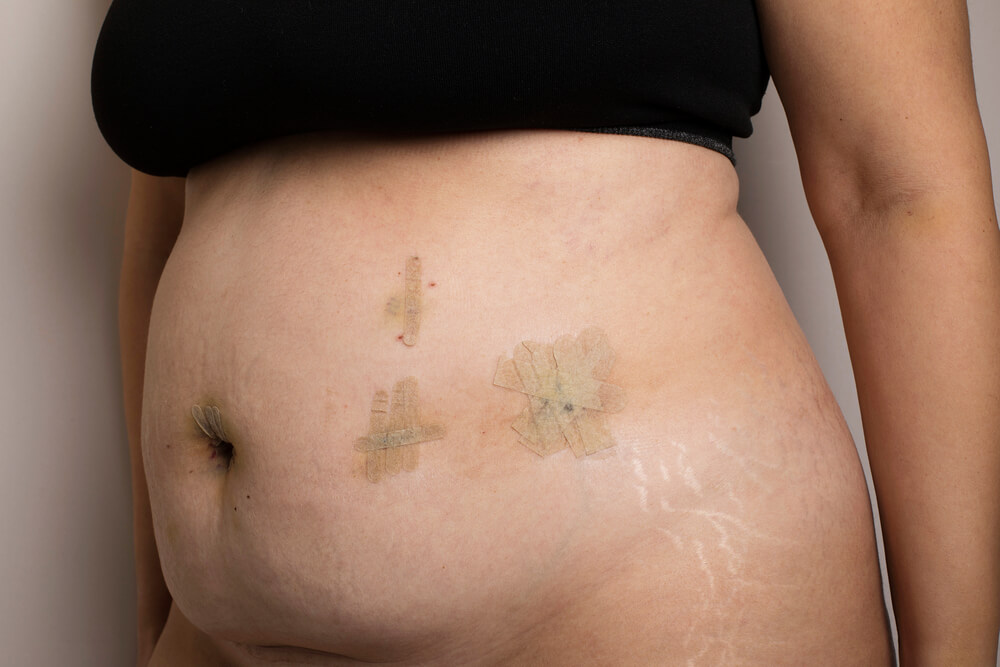 Woman abdominal scars after bariatric surgery