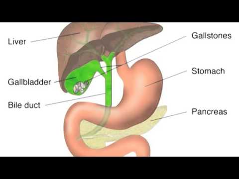 gallbladder-disease