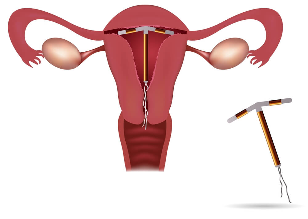 How Does An IUD Work