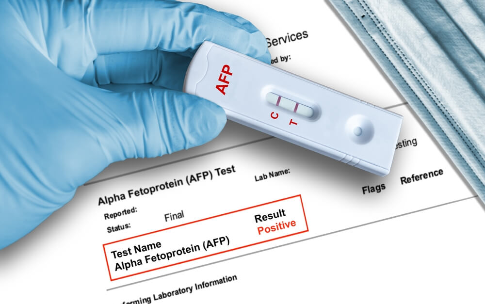 Alpha-fetoprotein (Afp) Positive Test Result by Using Rapid Testing Device.