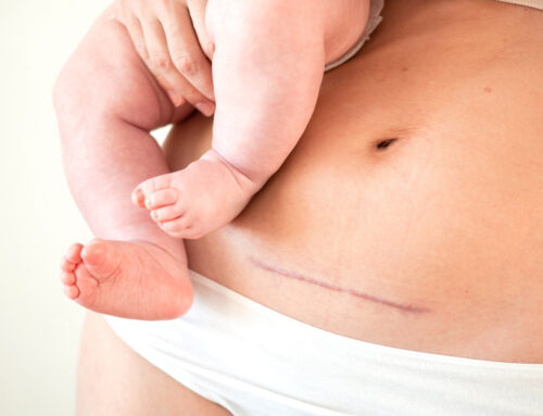 How to Prepare for a Cesarean Section: What to Expect Before, During, and After?