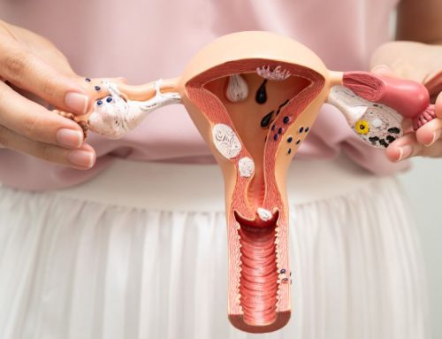 What Are Uterine Fibroids? Understanding Symptoms, Causes, and Treatment Options
