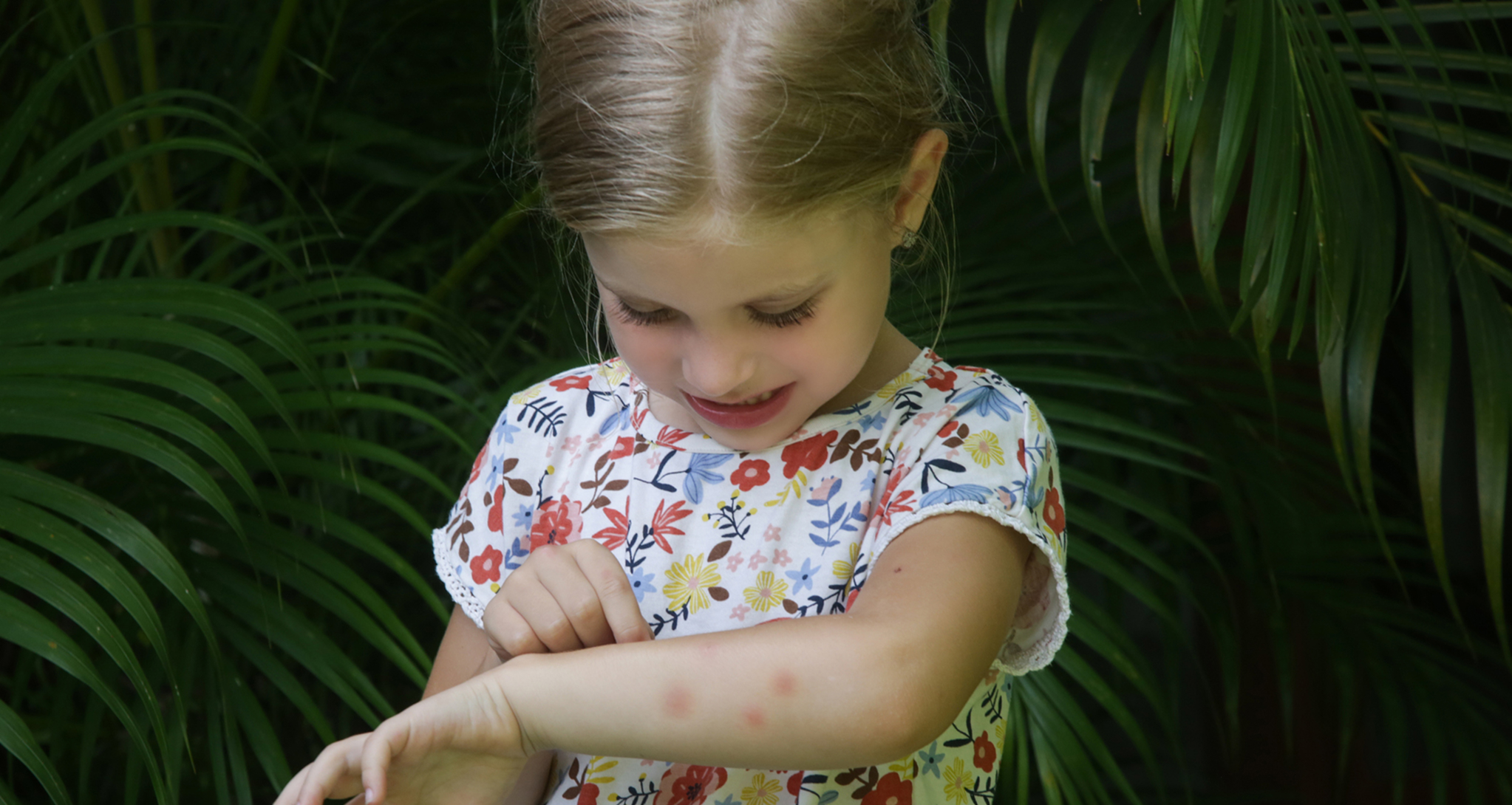 Little girl has skin rash from allergy or mosquito bites