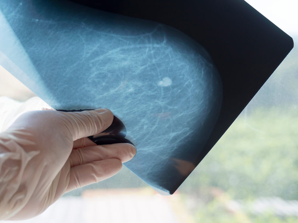 Mammography. The Doctor’s Hand Holding the Pictures. The Doctor Examines the Pictures in the Patient’s Room