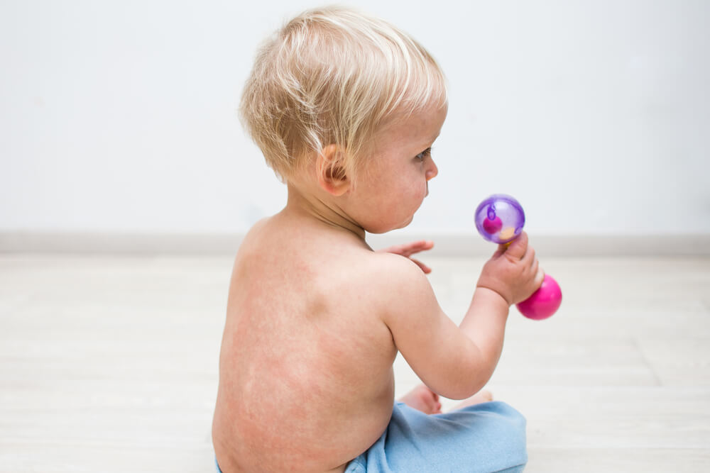 One Year Baby With Skin Rash on Back