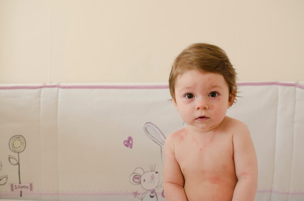 Baby Girl Body Covered With Roseola Skin Rash Sixth Disease