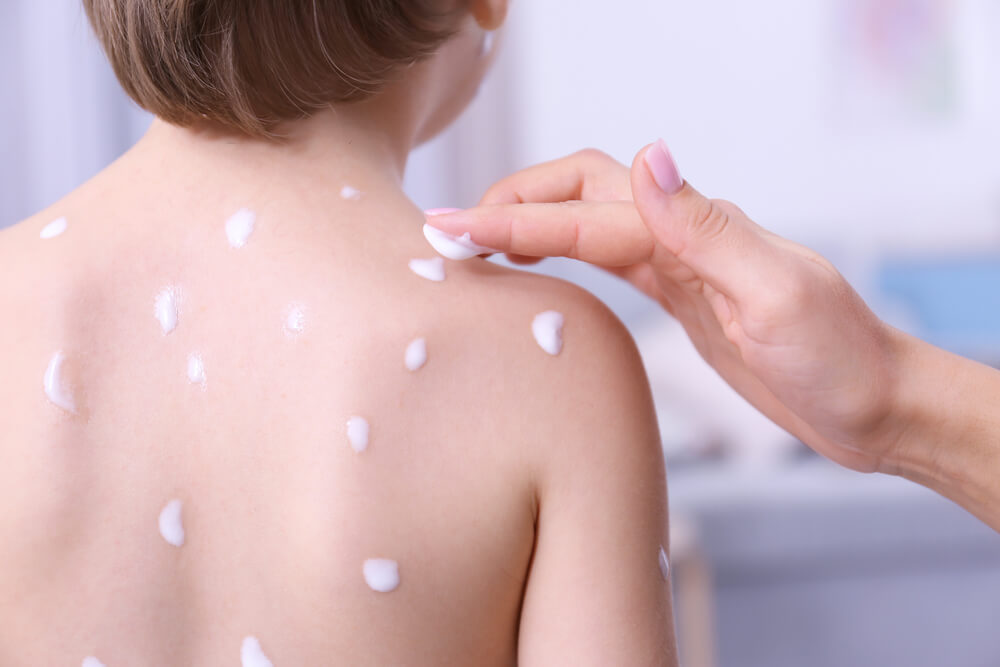 Woman Applying Cream Onto Skin of Child Ill With Chickenpox