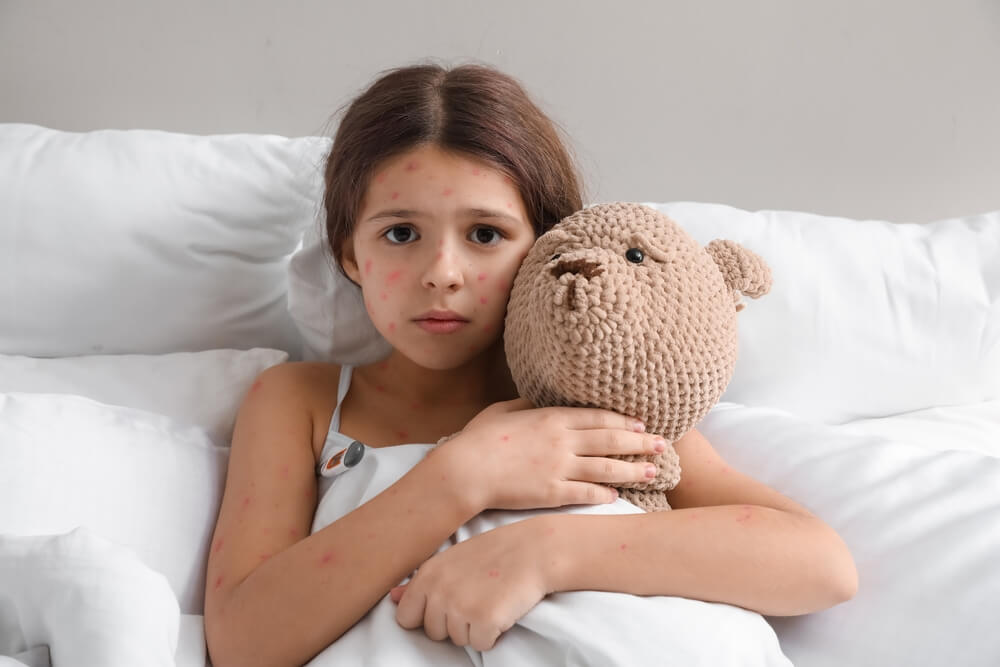 Little Girl Ill With Chickenpox in Bed
