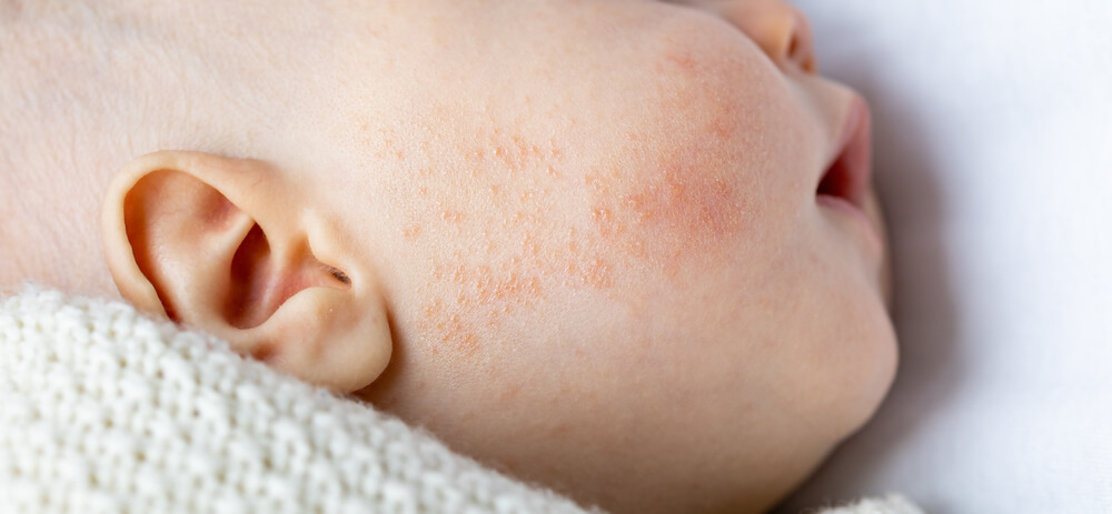 Close-up View of Baby Cheek With Allergy Rash Red Pimples or Atopic Dermatitis