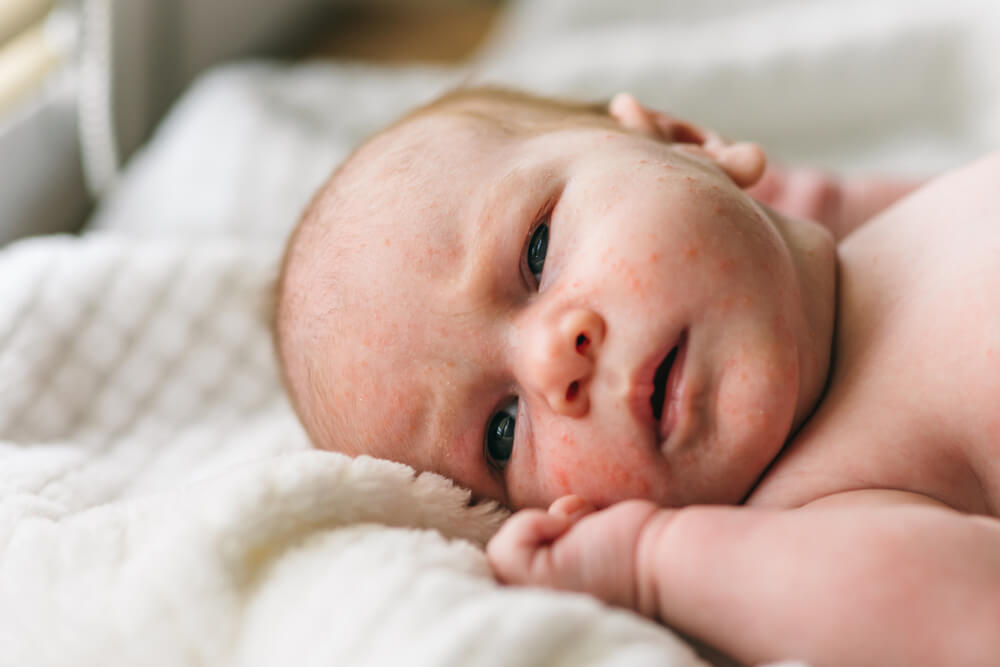 Baby Acne, Small Red and Purulent Inflammations on the Skin of the Face of a One-Month-Old Baby