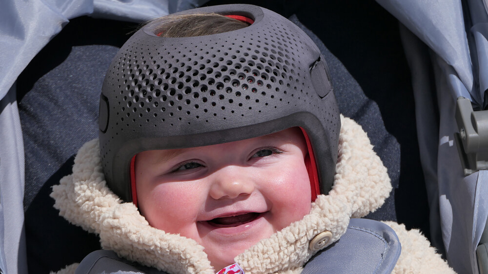Baby Girl Wearing a Cranial Remoulding Helmet for Flat Head