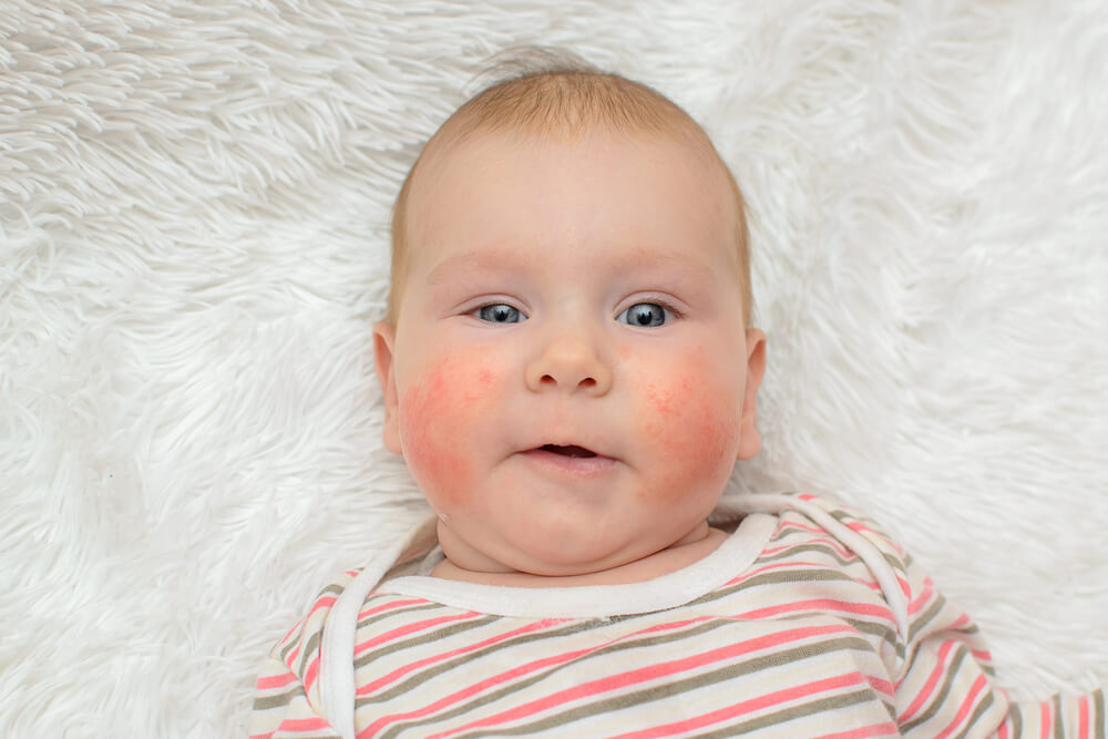 Beautiful Child Allergic Rash On The Cheeks Smiling On A White Background