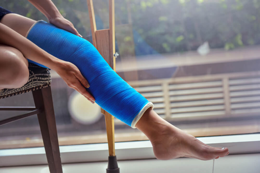 Blue Splint Knee Bandaged Leg Cast And Toes After A Running Injury Accidentyoung Woman In Blue Plaster Cast