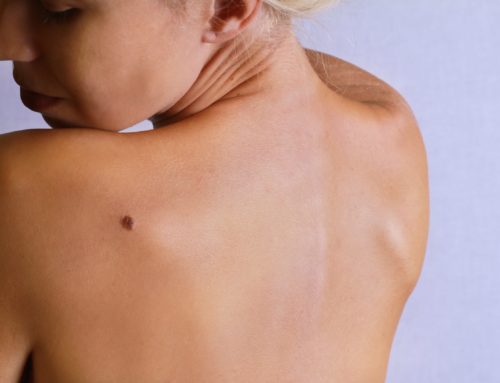 Everything You Need to Know About Skin Cancer Screenings