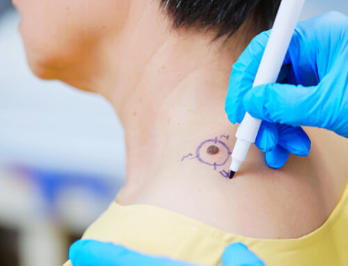 Mohs Surgery Recovery: How Long It Takes to Heal & What to Expect