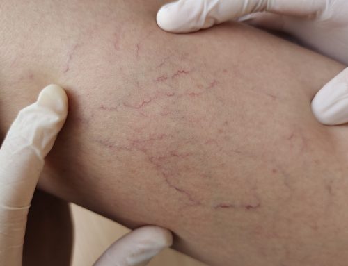 What Is Vascular Surgery, and How Is It Performed?