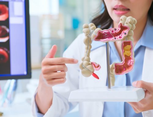 Colon Cancer: Symptoms, Stages, and Treatment